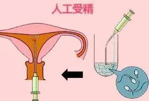 女性取卵手術(shù)